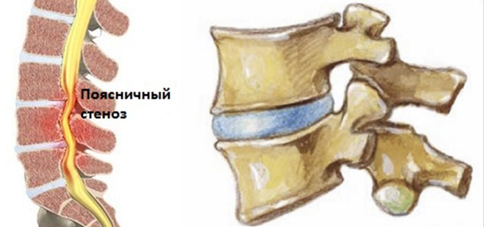Стеноз наглядно Поясничный стеноз наглядно