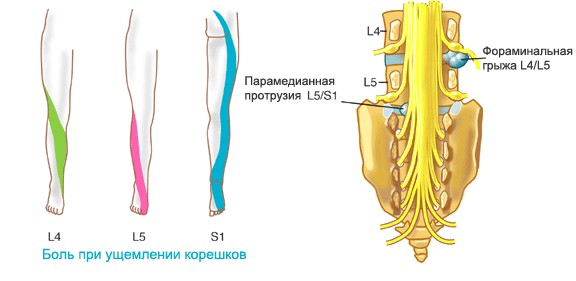 Ущемление корешков Боль при ущемлении корешков